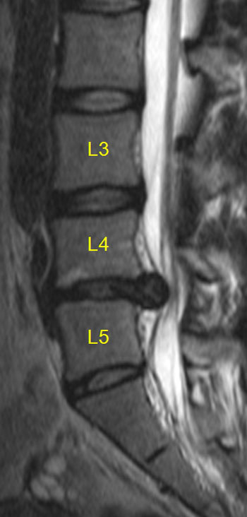 椎間板ヘルニアによって腰椎の間隔が狭まり、神経を圧迫している様子を示すレントゲン画像