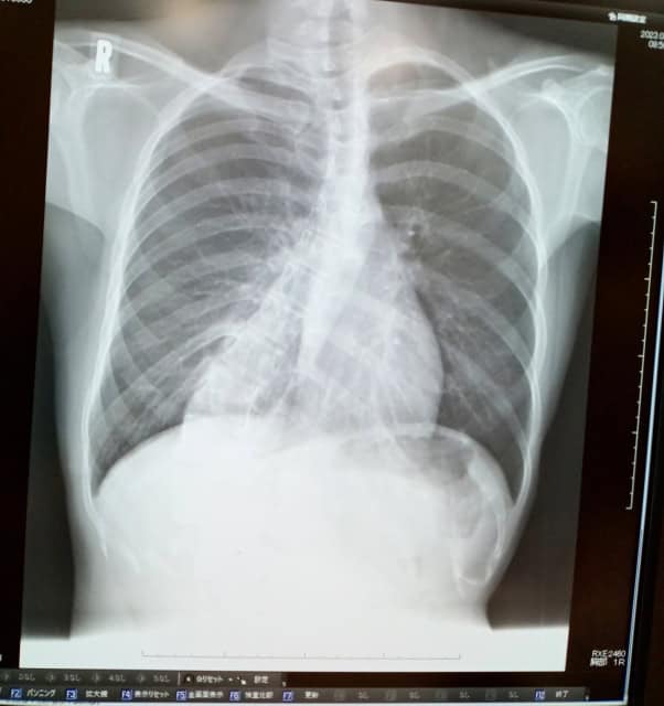 側弯症のレントゲン画像