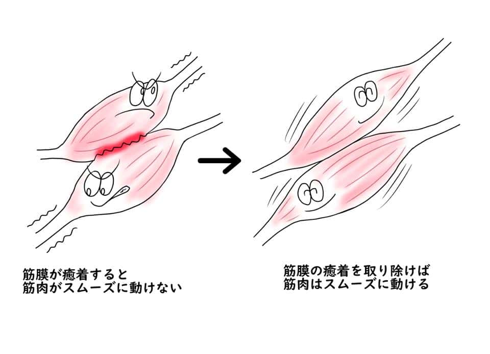 筋肉の癒着のイメージ画像